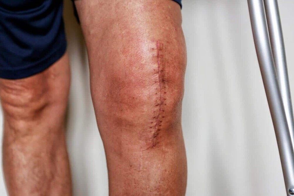 knee replacement surgery