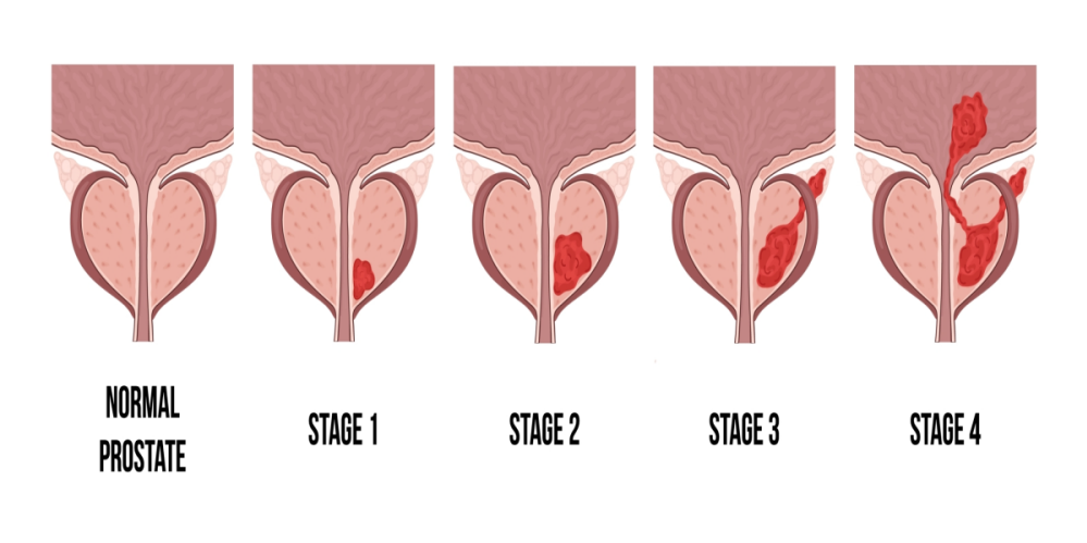 Prostate 4 stages